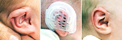 EarWell System Device